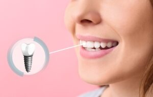 low price tooth implants sydney